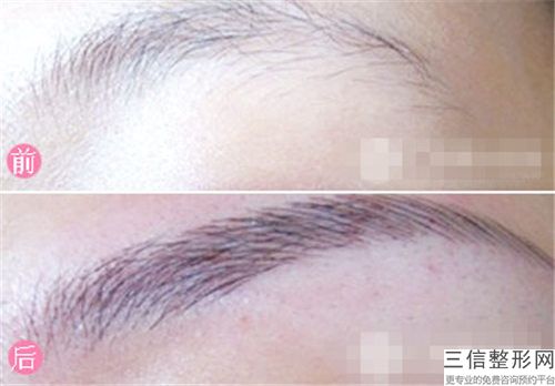 繡眉紋眉眉毛種植整容效果能保持多久