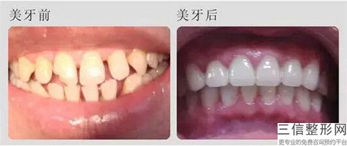 齙牙做美容冠對孩子有哪些影響