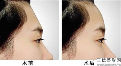 全國哪個整形醫院愛貝芙填充額頭良好：愛貝芙填充額頭醫院前50有哪個