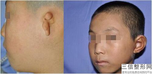 成都耳朵再造術后常發生的9種后遺癥