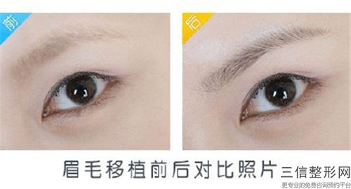 做種睫毛手術危害有哪些
