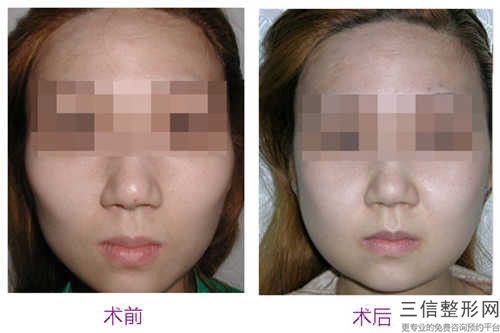 全國磨下頜骨手術醫院推薦：磨下頜骨手術醫院前50名都有哪些