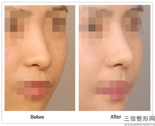 巴音郭楞假體耳軟骨隆鼻是否存在安全隱患