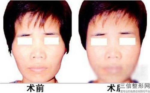 膠原蛋白注射豐太陽穴后是否影響懷孕呢