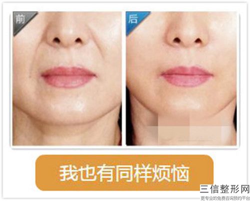 妊娠紋治療會產生危害嗎_妊娠紋治療矯正術有危險嗎