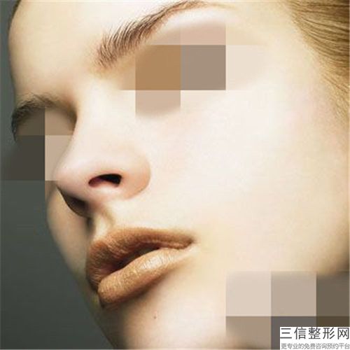 駝峰鼻作用是否持久_駝峰鼻可維持的時間