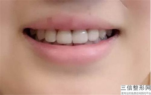 做超聲波洗牙失敗修復整形術適合那些人群
