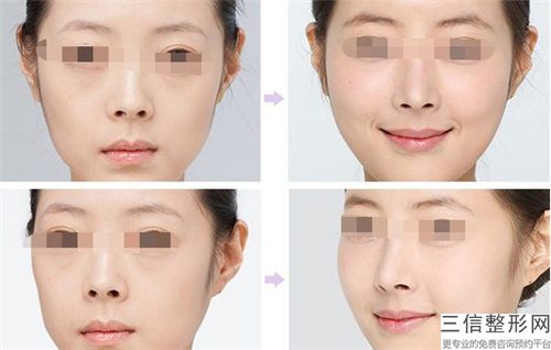 假體墊鼻整形術作用可以維持多久