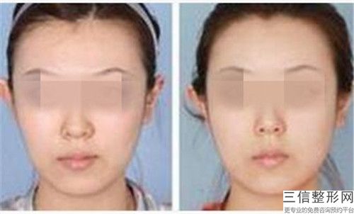 牙齒仿生復合瓷貼面傷害肌膚嗎