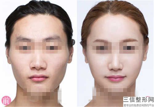 牙齦上骨頭突出術能維持什么時候