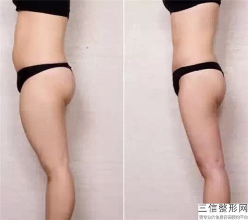 提臀跟豐臀個(gè)手術(shù)效果自然嗎維持效果時(shí)間久嗎