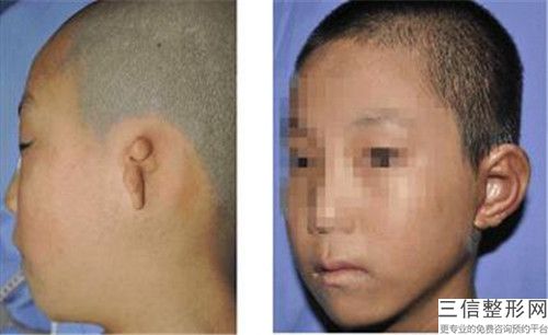 全國耳廓再造手術醫院推薦：耳廓再造手術醫院前50名誰個好
