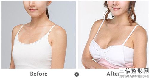 眼窩凹陷整形會傷害耳朵嗎(眼窩凹陷整形會傷害乳腺嗎)