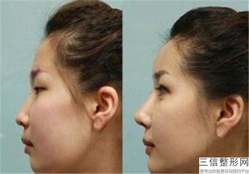 蒜頭鼻矯正需要做哪些術后護理