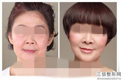 海南省海口人民醫院整形美容科價格收費表附+醫院簡介-激光除頸紋案例