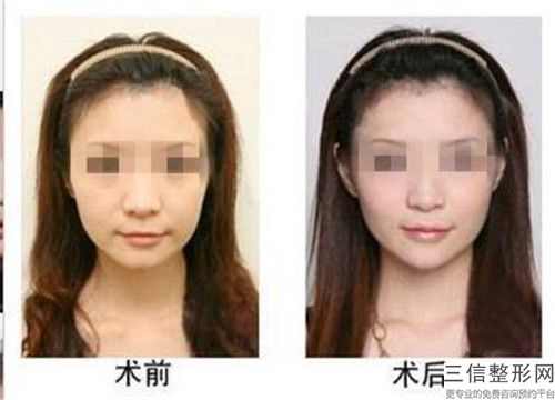 注射豐太陽穴的后遺癥都有哪些