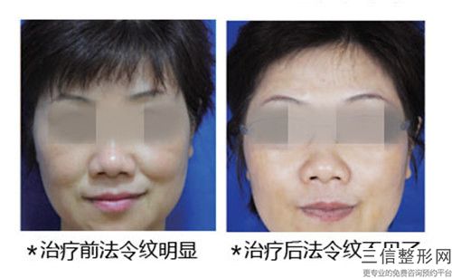 國內(nèi)哪家整形醫(yī)院白色生長紋消除好：白色生長紋消除醫(yī)院前50名誰做得好