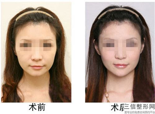 廣元市知名透明質酸豐蘋果肌機構-廣元市透明質酸豐蘋果肌醫院在榜名單前十是時候發布了
