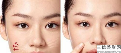 去除生長紋失敗修復(fù)整形的適合人群
