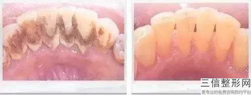韓國登特斯Dentis種植牙手術(shù)的術(shù)后護理重點有哪些