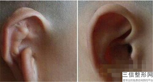 全國耳廓整形手術醫院推薦：耳廓整形手術醫院top50強都是技術流派