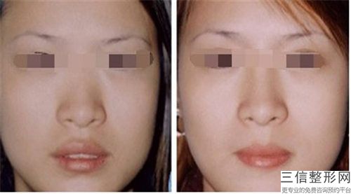全國全鼻矯正醫院推薦：全鼻矯正醫院前50提前告知