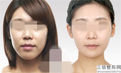 全國墊下巴顯臉長醫院推薦：墊下巴顯臉長醫院前50強實力突出
