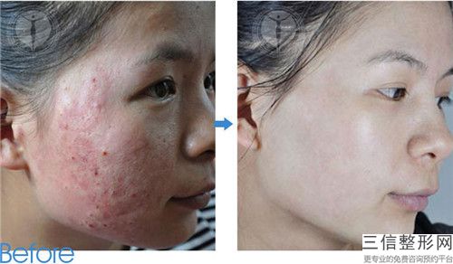 杭州善慈醫(yī)療美容診所痘印修復祛痘印手術安全嗎，有沒有后遺癥