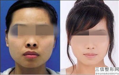 做陰唇肥大手術的危害有什么呢