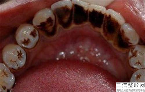 信陽人工種植牙手術(shù)可持續(xù)時(shí)間可達(dá)多久