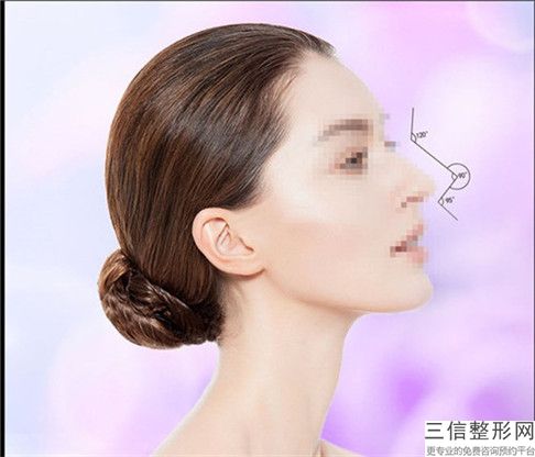 張小紅醫生整形鼻翼縮小口碑分享-義烏張小紅整形醫院