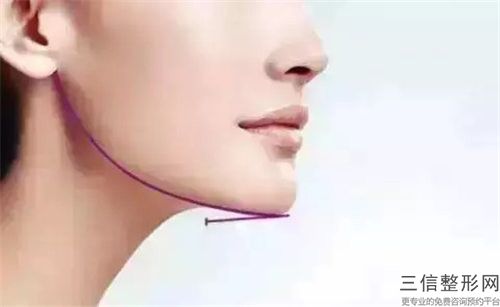 運城微晶瓷墊下巴做不好會有什么后果