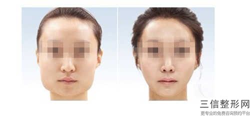中國手術顴骨手術的醫(yī)生哪個口碑比較好：手術顴骨手術醫(yī)生前50位全新版