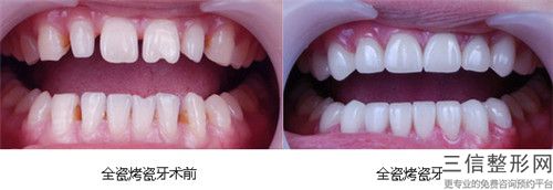汕頭鑲一個陶瓷牙冠價格和啥有關