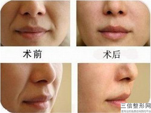 溫州市曹?chē)?guó)洲醫(yī)生,吳毓萍醫(yī)生祛除紋身技術(shù)比拼
