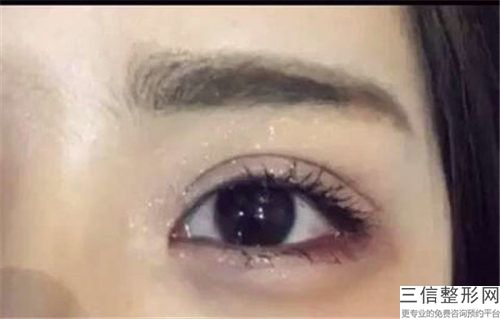 種睫毛手術手術方法及風險