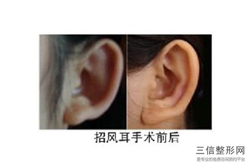 東莞市第八人民醫院耳朵向后貼矯正術后反饋分享-附整形收費明細
