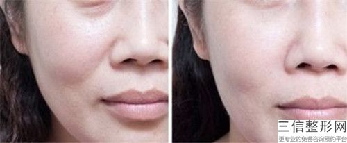 全國內窺鏡面部提升醫院推薦：內窺鏡面部提升醫院top50來挑選