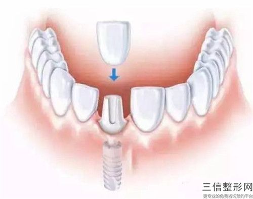 泰州牙齒內傾斜矯正手術的價格大概是多少錢