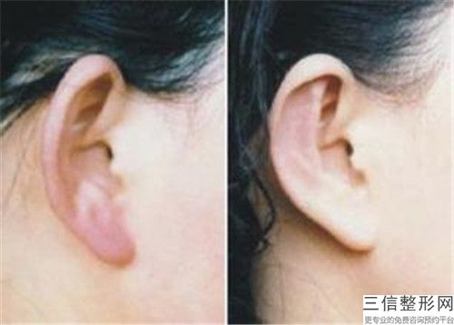 國內耳朵外形畸形醫院推薦：耳朵外形畸形醫院前502025較新榜單