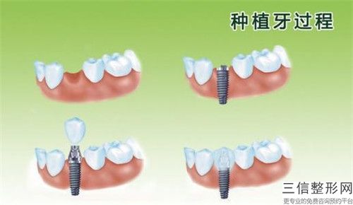 鹽城醫生拔牙齒對人體是否有危害呢