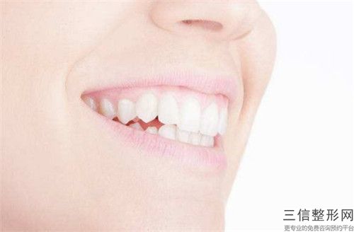 石家莊成年齙牙糾正手術的價格
