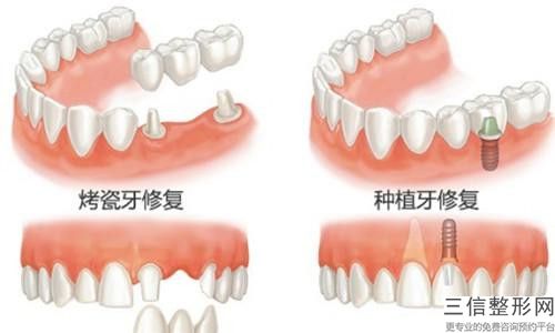 貴陽人劇醫學美容診所洗牙美白的手術后遺癥