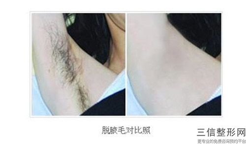 成都雍禾植發醫院打童顏針填充的價格是怎樣的呢