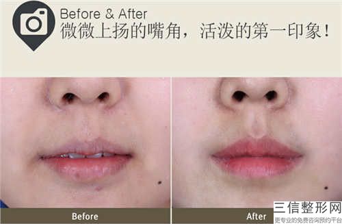 宜春陰唇私處整形價位多少