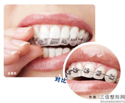 南寧德國精品3d烤瓷牙后的護理和保養