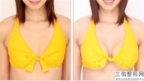 襄陽市劉軍整形醫生乳內陷手術價格是少錢呢