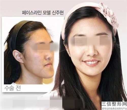 石家莊市哪個美容醫院嘴唇裂紋修復好(石家莊盛蓮醫療美容服務遍布省內各地)