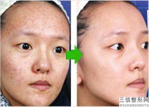 中國哪個醫生痘印痘坑手術好：痘印痘坑手術醫生前50佳全網安利商丘振華醫