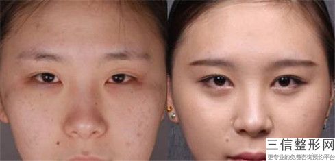 歐式芭比眼綜合矯正有壞處嗎會有什么傷害
